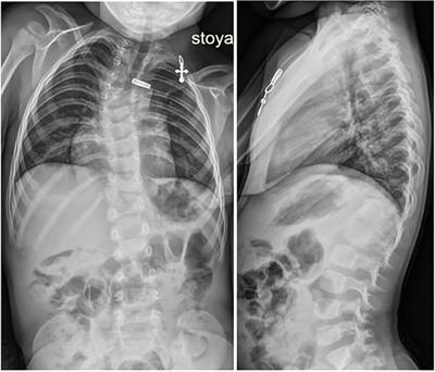 Abdominal pseudohernia in a child after surgical correction of congenital scoliosis: case report